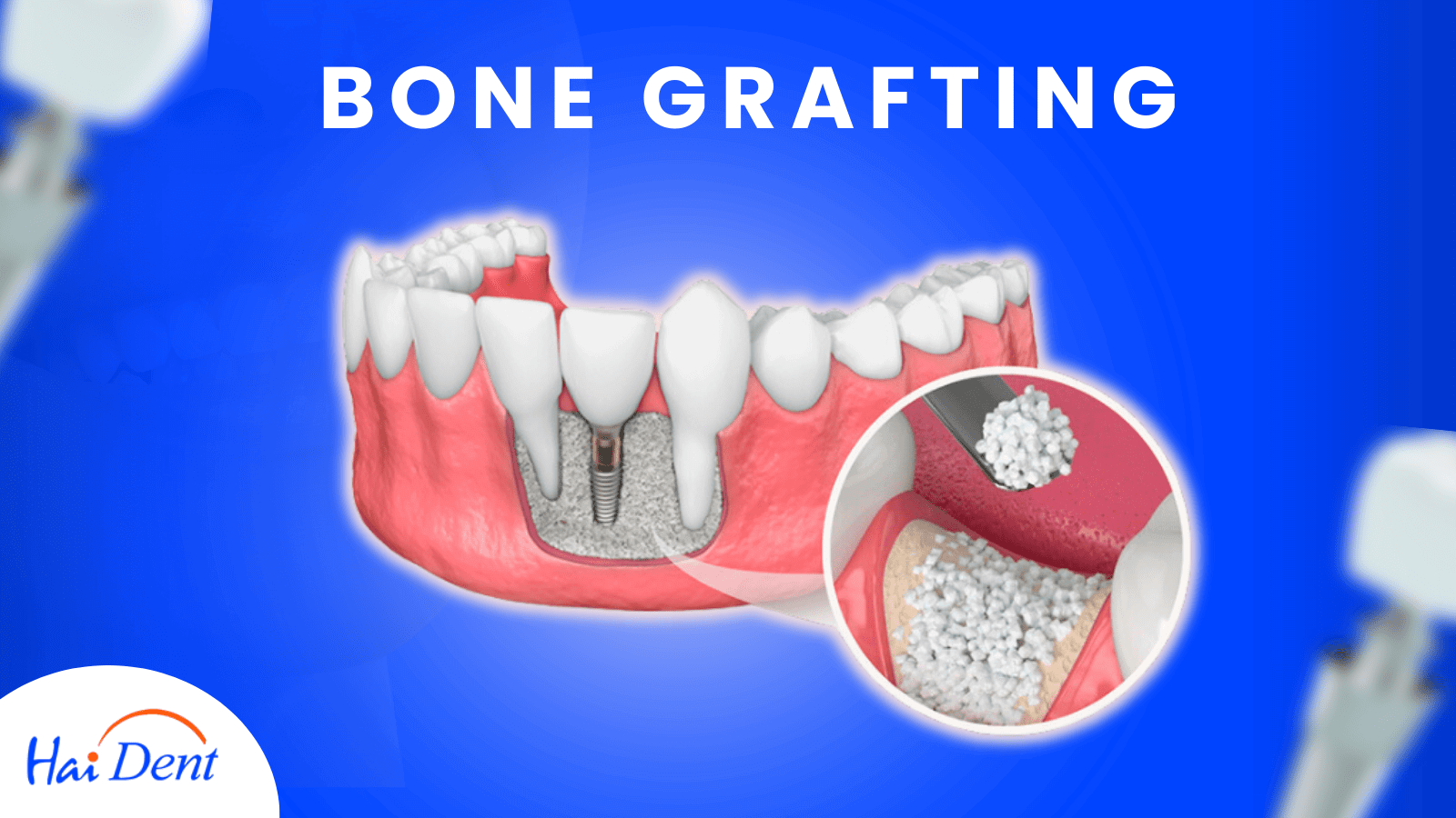 Dental bone grafting cost in india